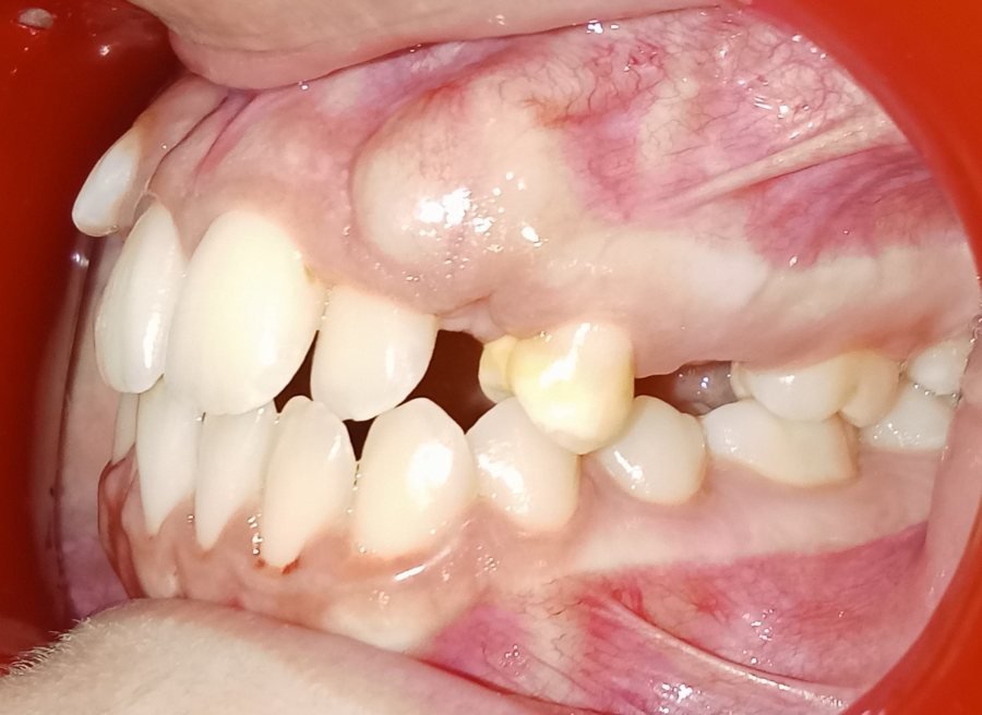 Impacted canine other side before treatment