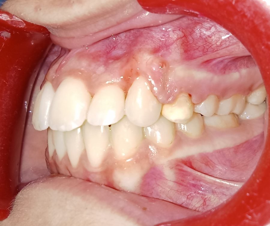 Side view after treatment