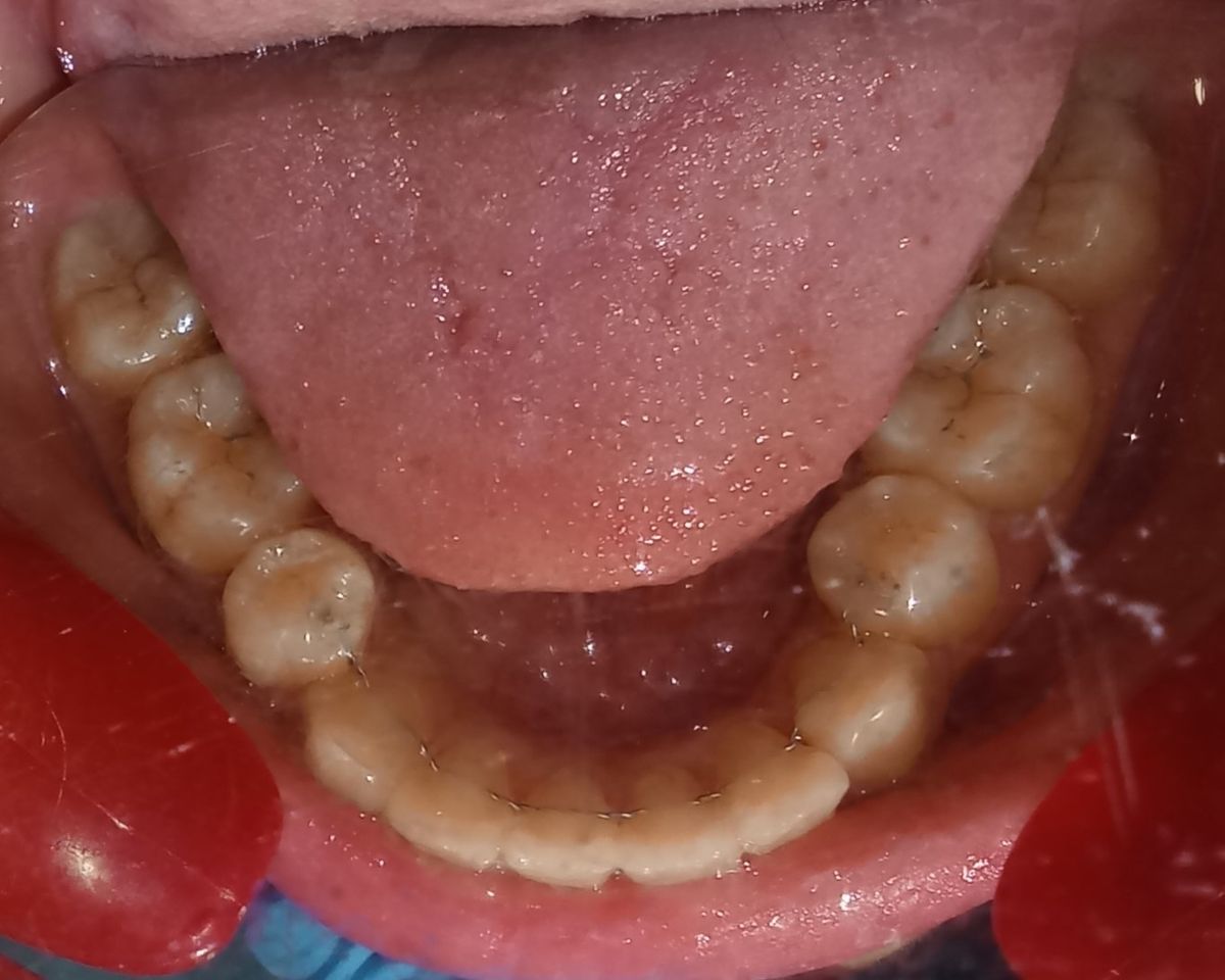 After — lower arch occlusal view, fully aligned with bonded retainer