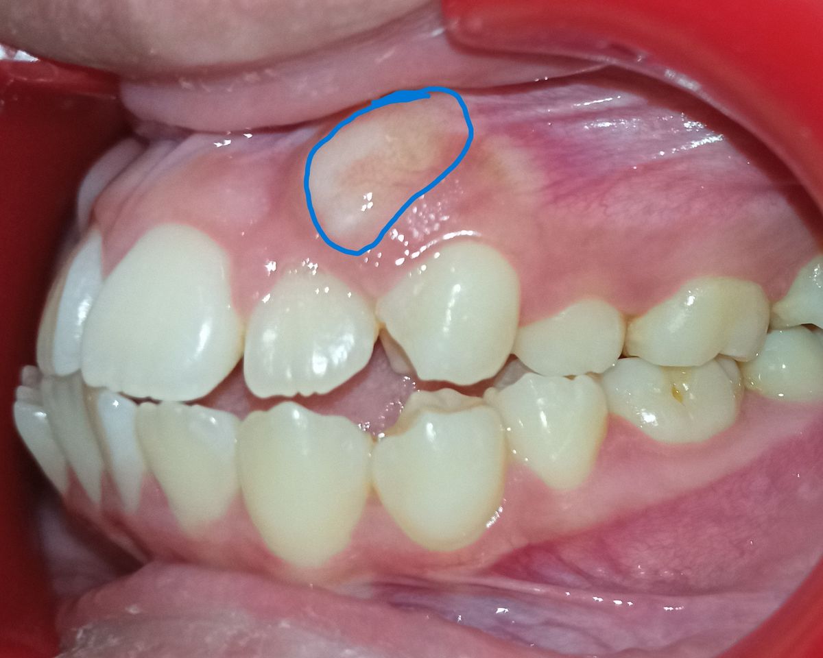 Before — right lateral view, impacted canine marked beneath the gum