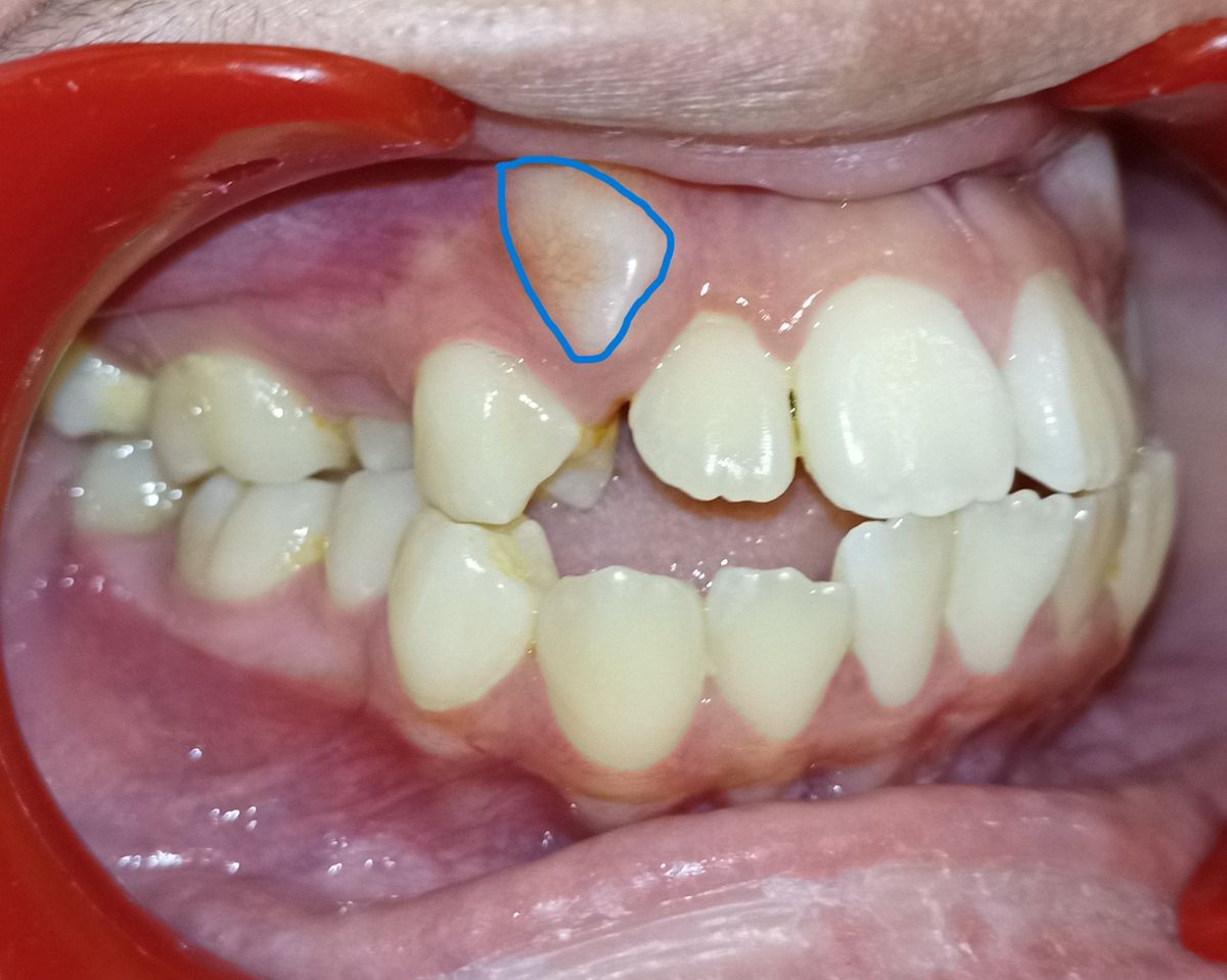 Before — left lateral view, impacted canine marked beneath the gum