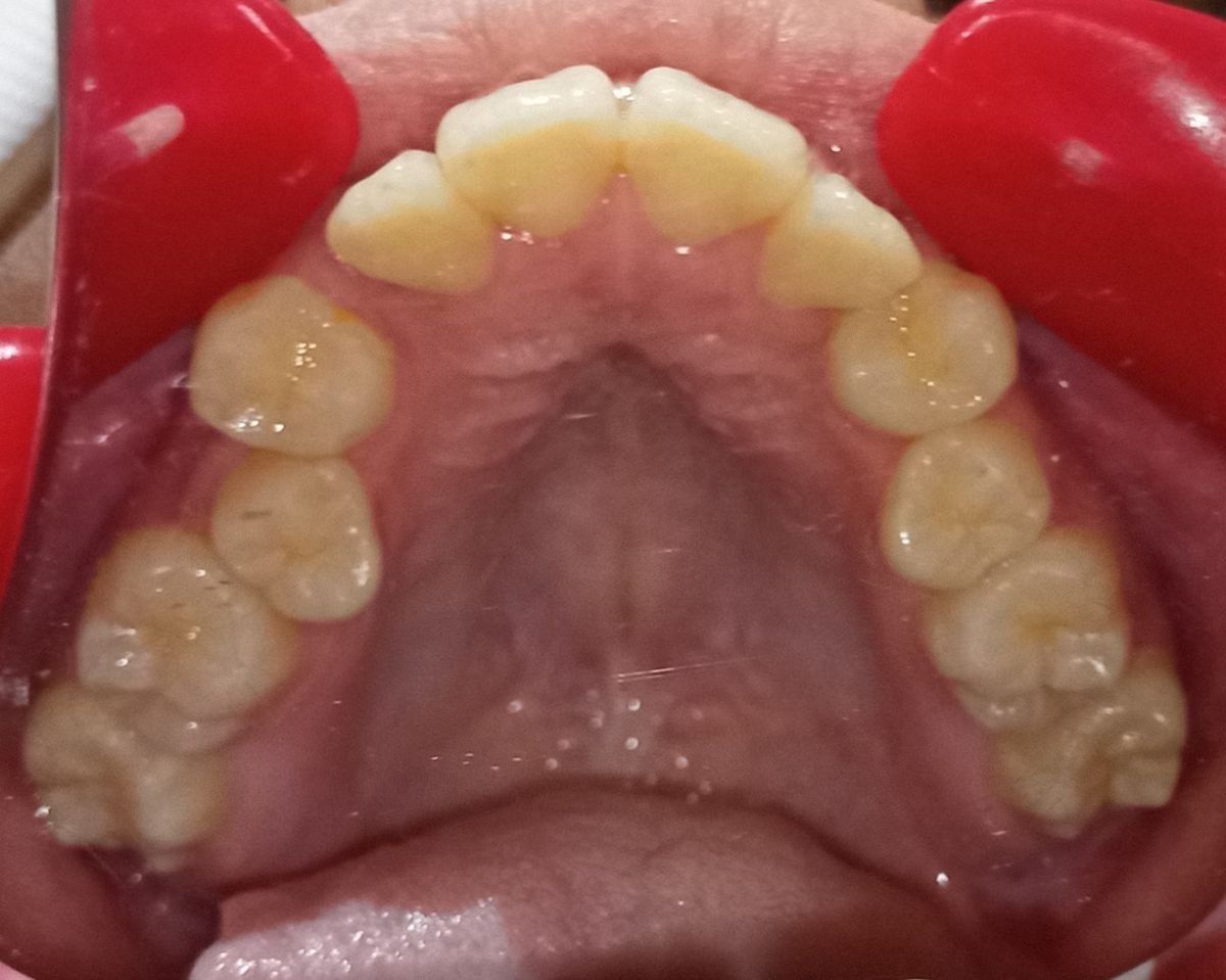 Before — upper arch occlusal view showing crowding