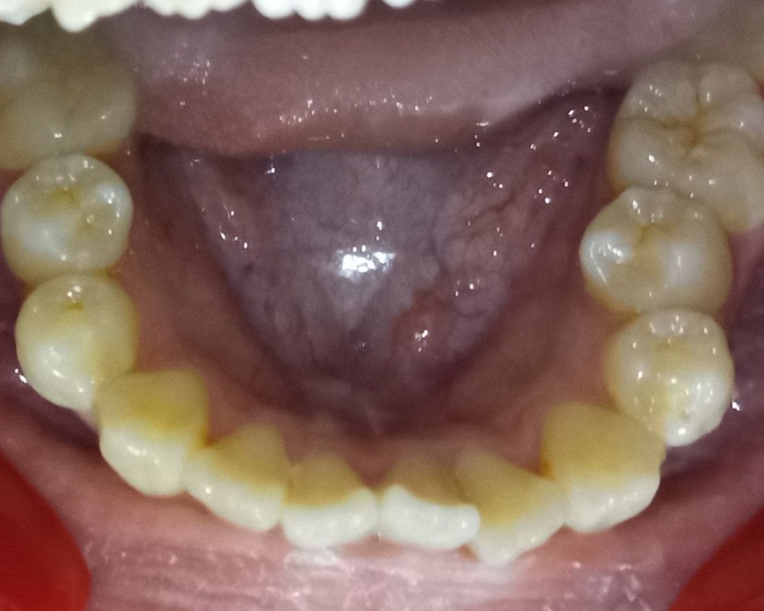 Before — lower arch occlusal view