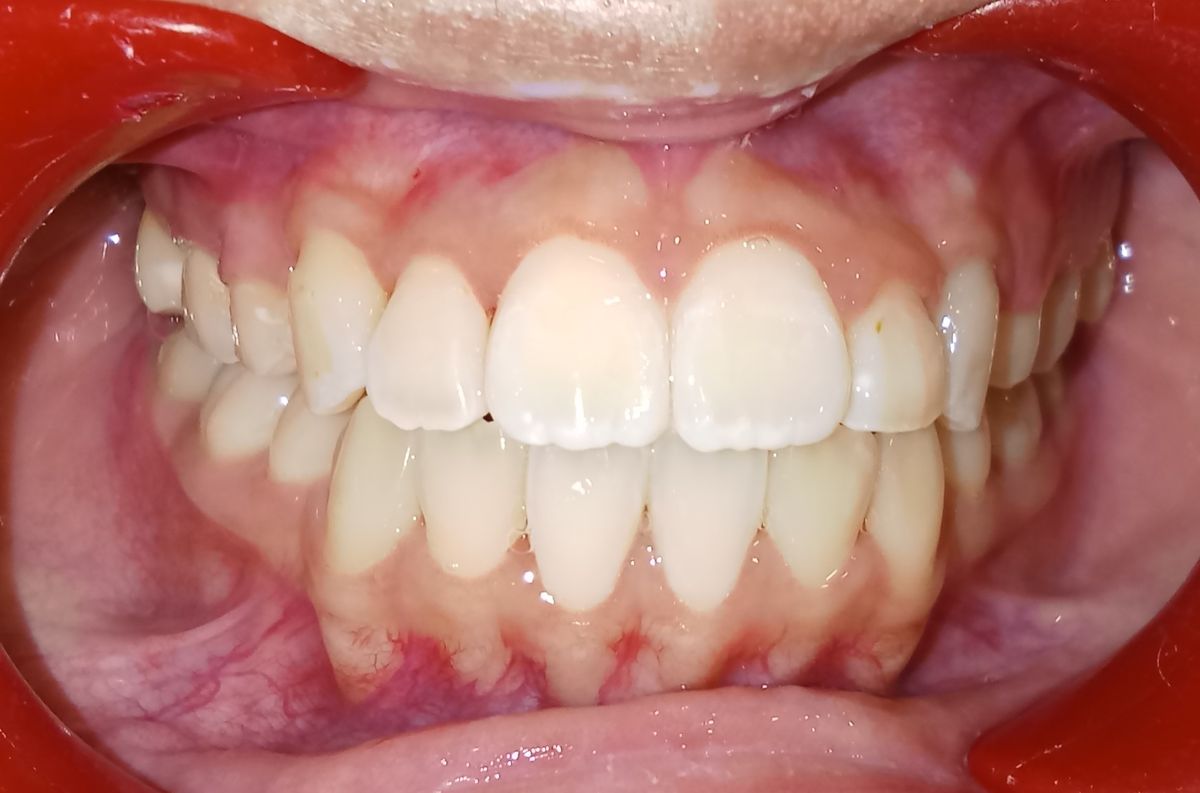 After — frontal view, teeth fully aligned