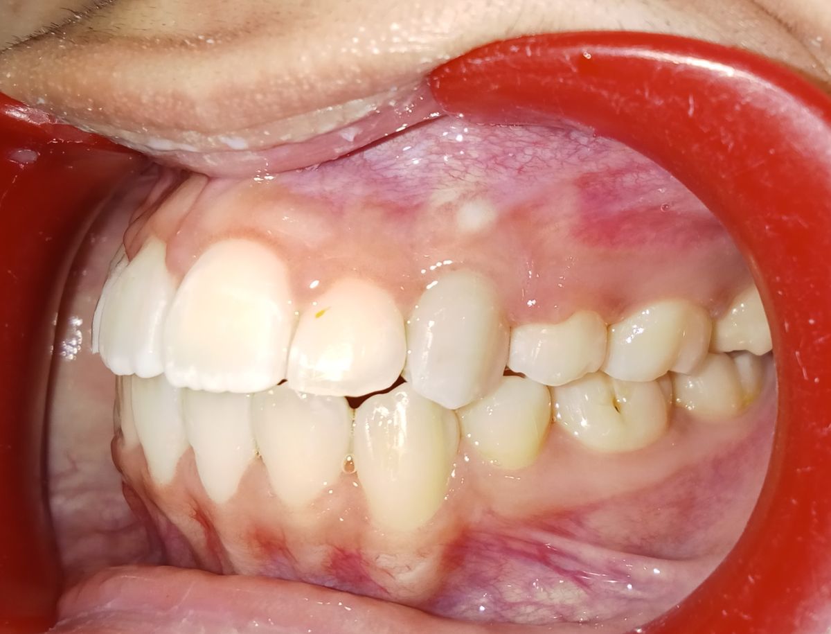 After — right lateral view, canine fully erupted and aligned