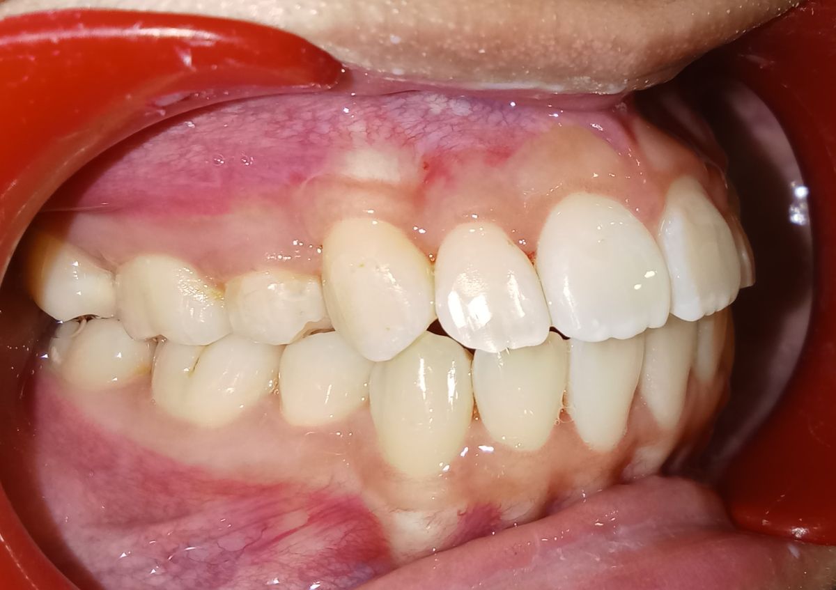 After — left lateral view, canine fully erupted and aligned