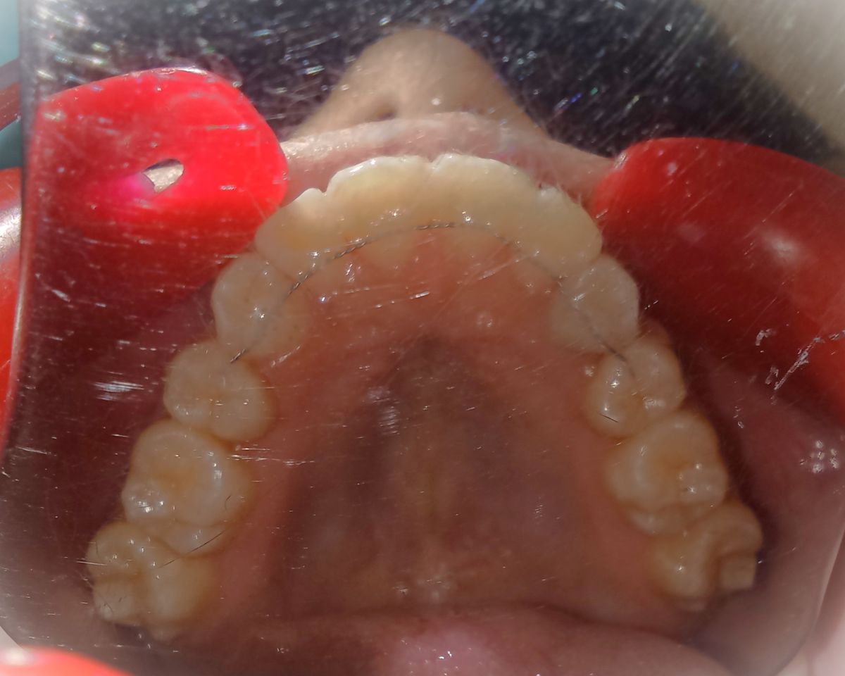 After — upper arch occlusal view, canines aligned with bonded retainer