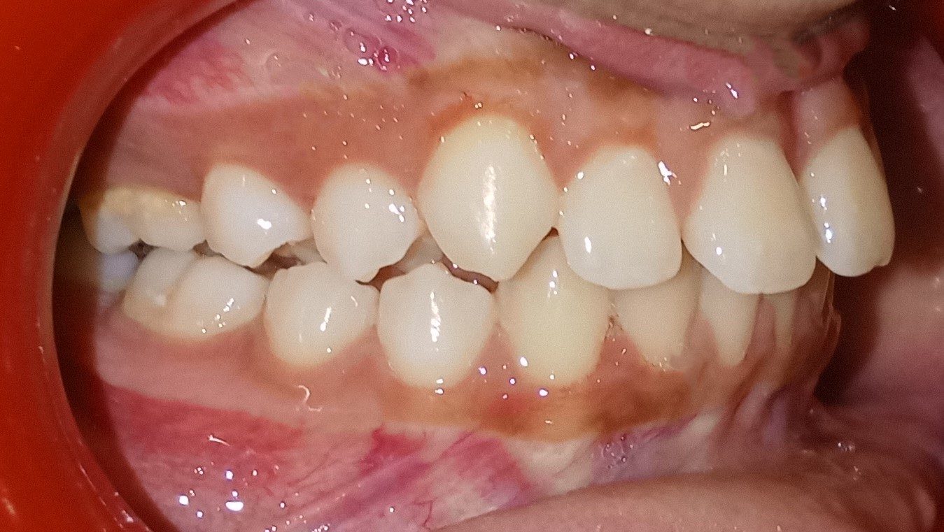 Before — right lateral view