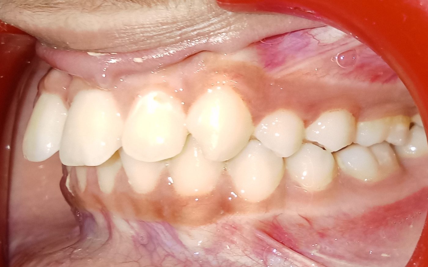Before — left lateral view