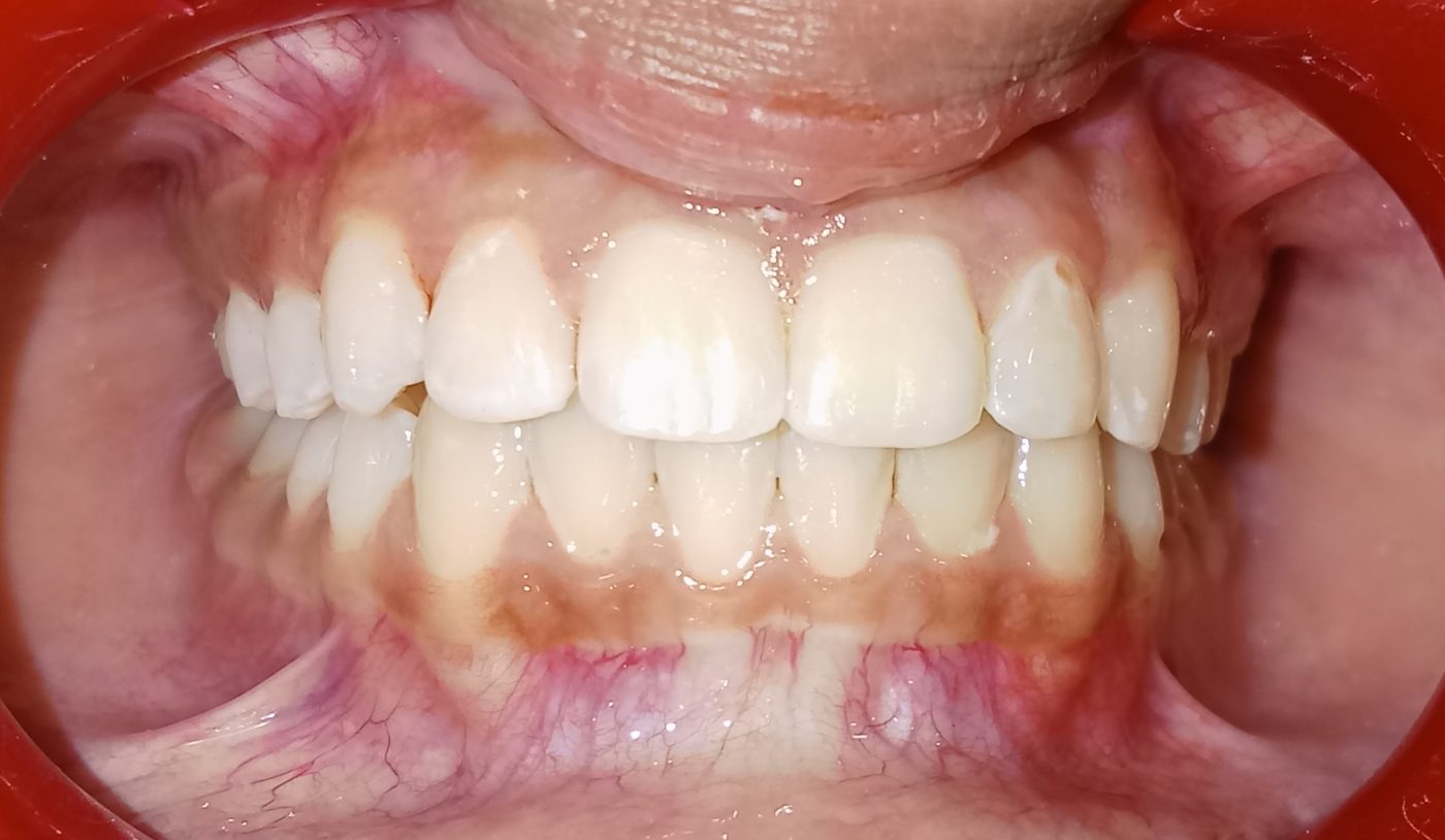 After — gap closed with Invisalign