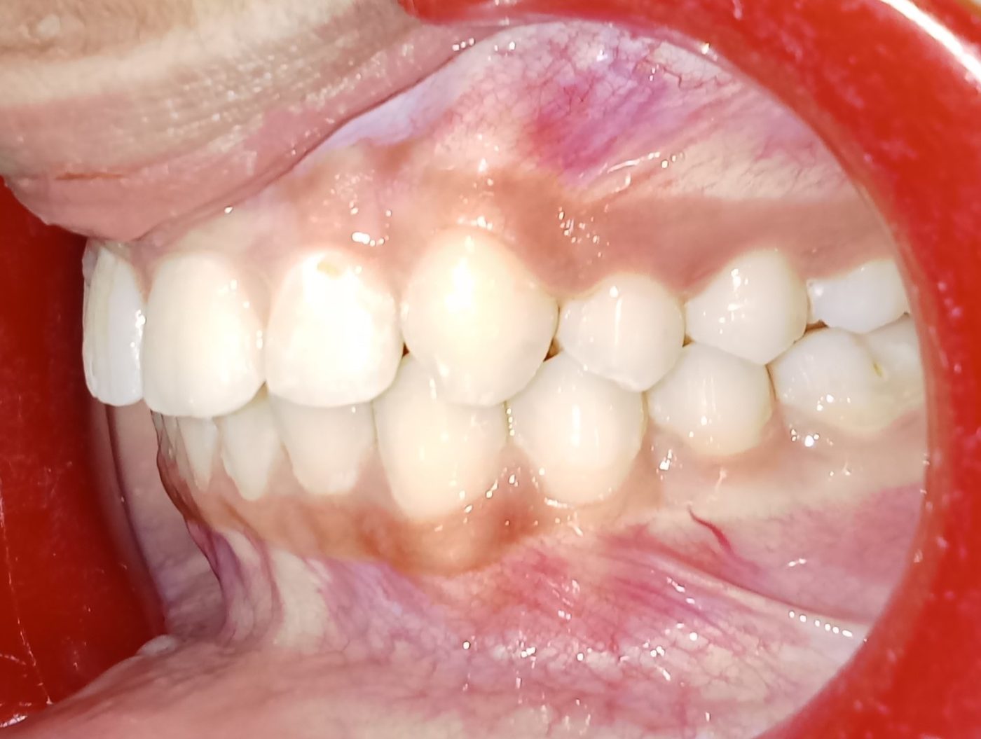 After — left lateral view
