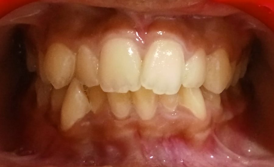 Crowded teeth front view before clear aligners