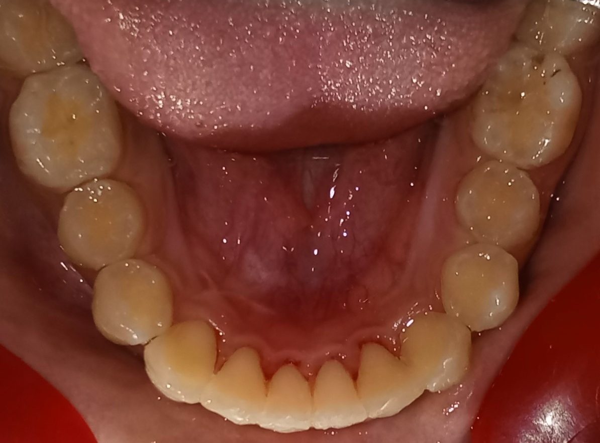 After — lower arch occlusal view, fully aligned
