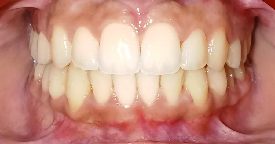 Aligned teeth front view after clear aligners