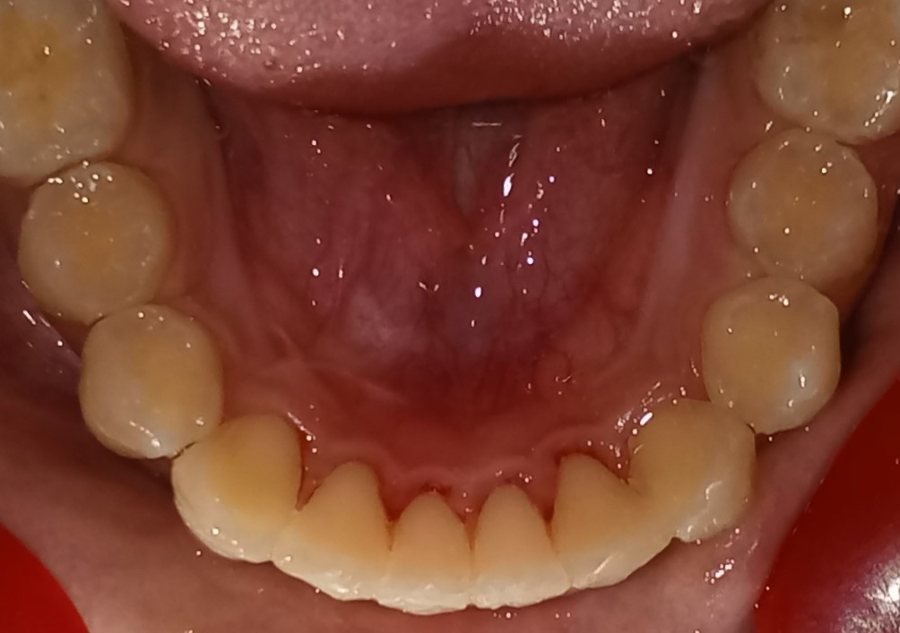 Lower arch after