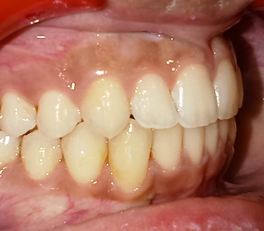 After — left lateral view