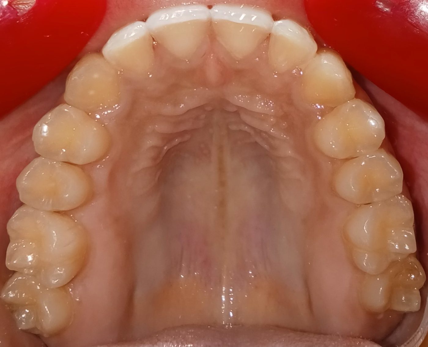 After — upper arch occlusal view, fully aligned