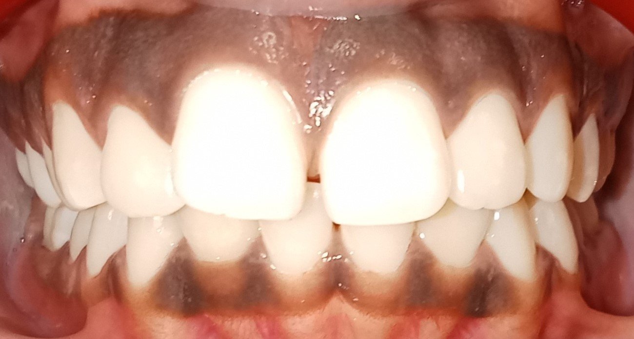 Before treatment — frontal view