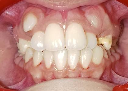 Before and after braces results in Doha