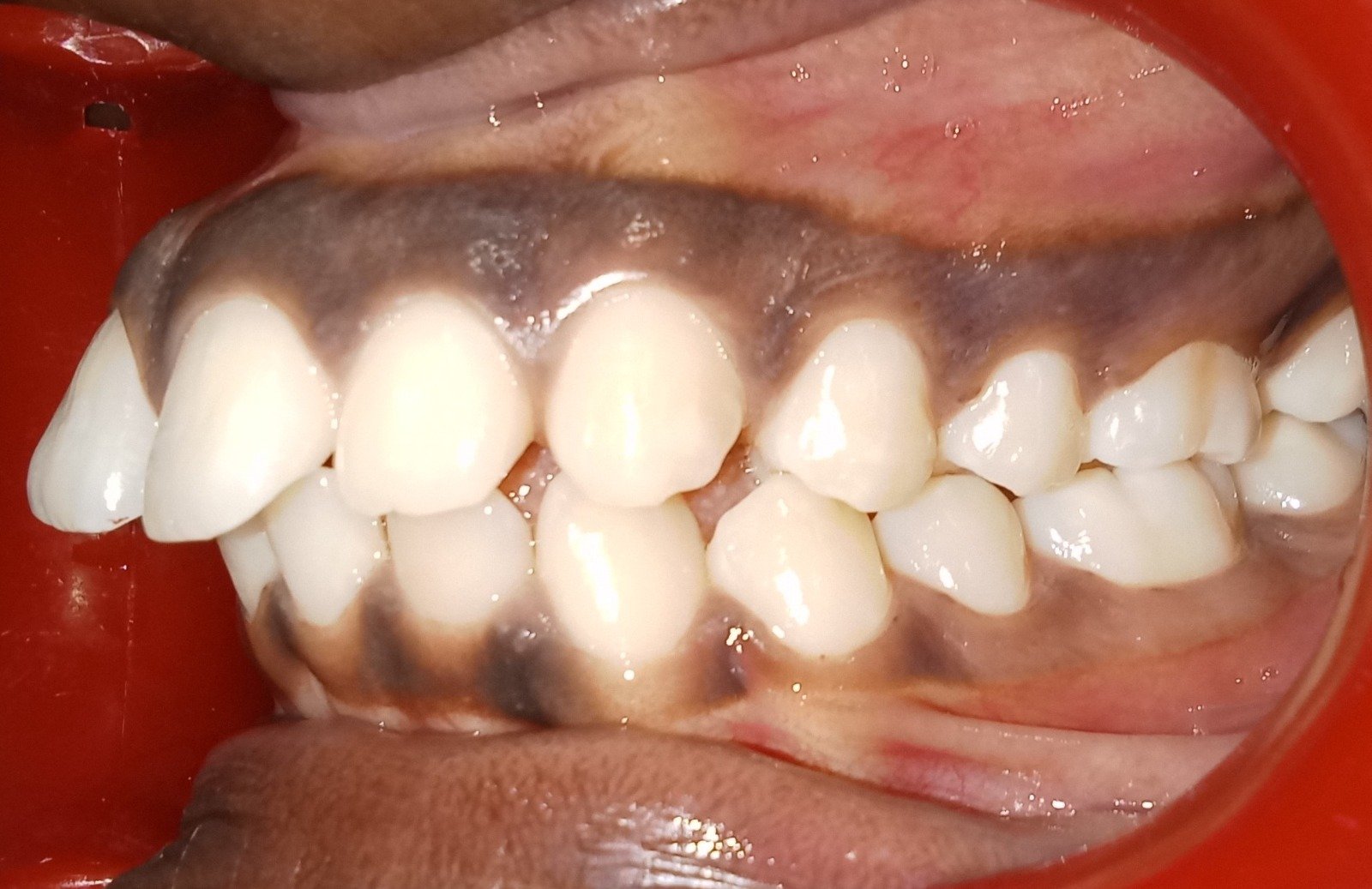 Before treatment — left side view
