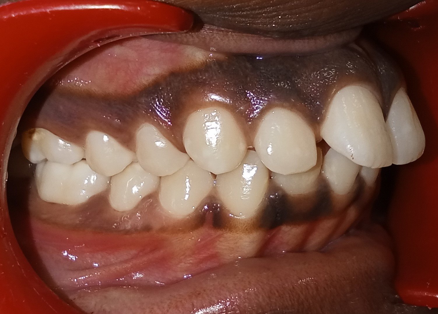 Before treatment — right side view