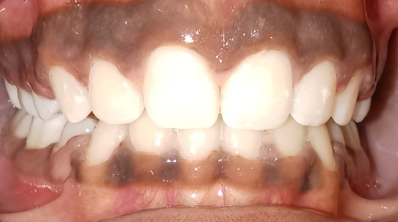 After treatment — frontal view, balanced smile