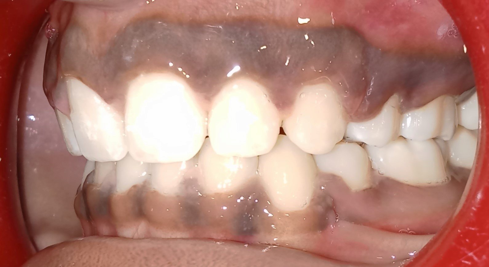 After treatment — left side view