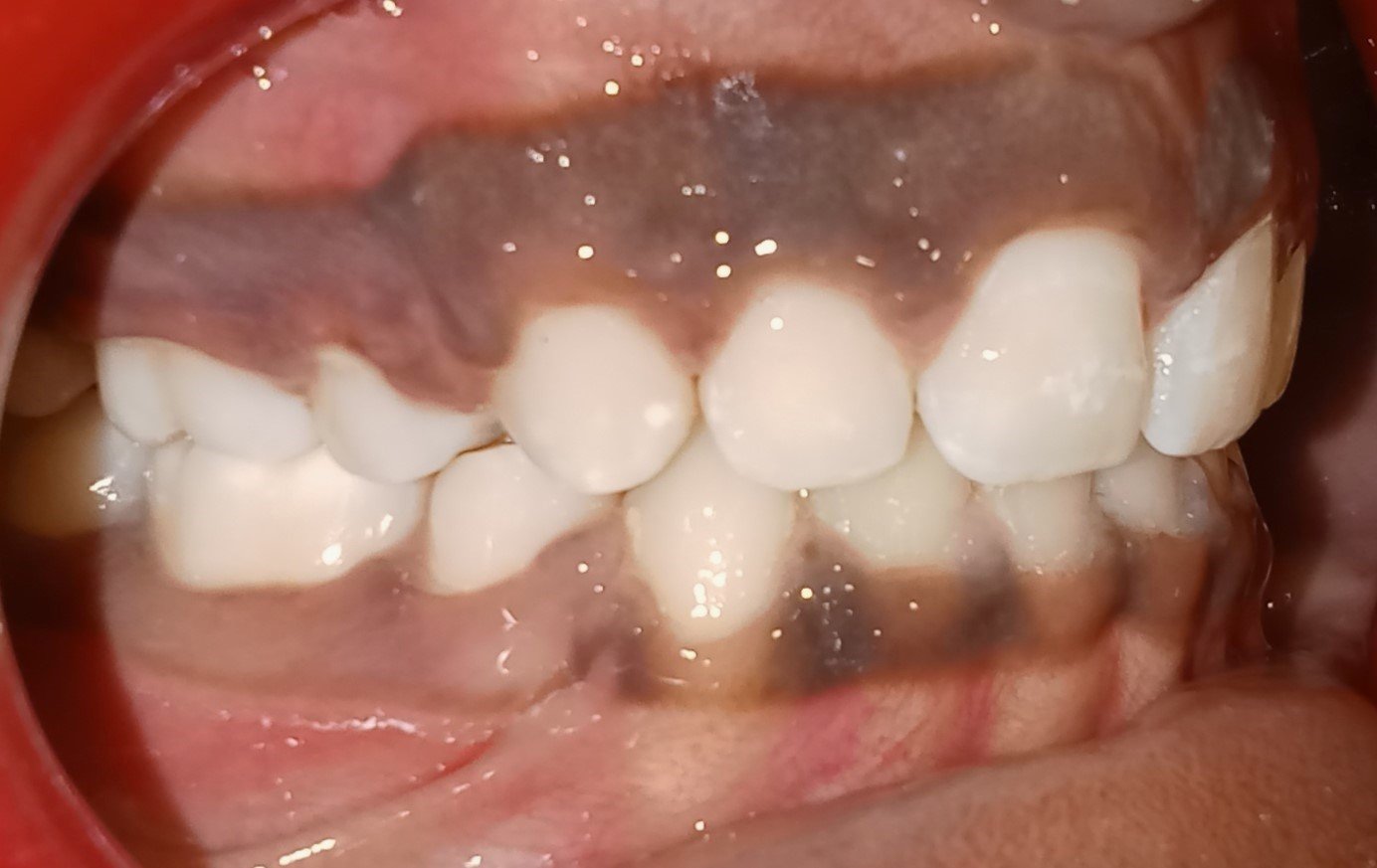 After treatment — right side view