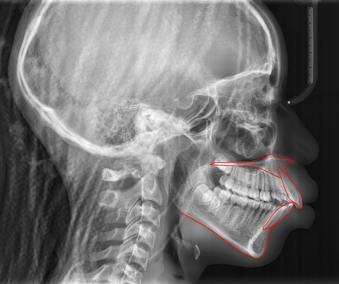 Cephalometric X-ray before treatment showing forward angulation of the upper and lower front teeth