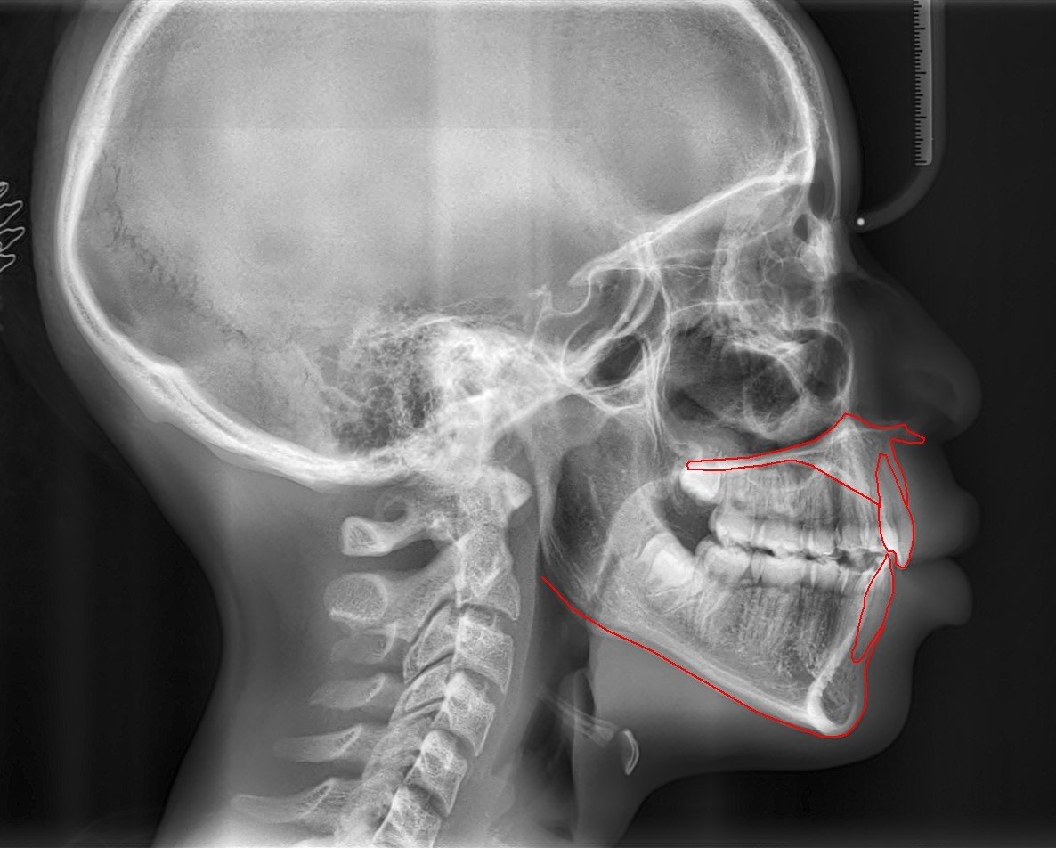 Cephalometric X-ray after treatment showing corrected, upright angulation of the upper and lower front teeth