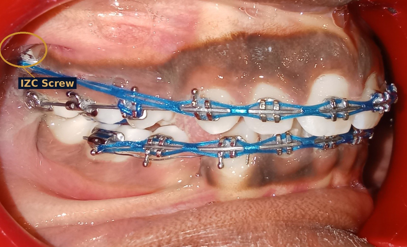 Anchor screw (IZC screw) placed in the gum during treatment to support the jaw correction without surgery