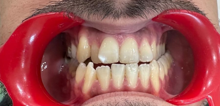Anterior openbite front view before