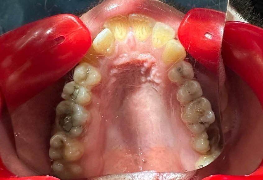 Upper arch occlusal view before