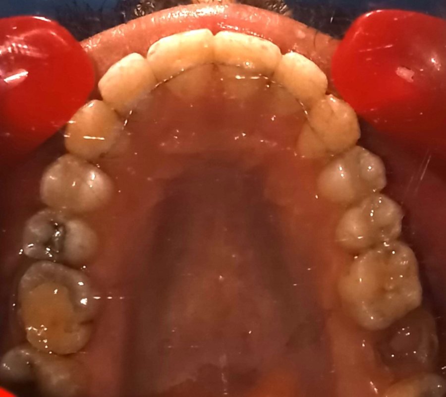 Upper arch occlusal view after