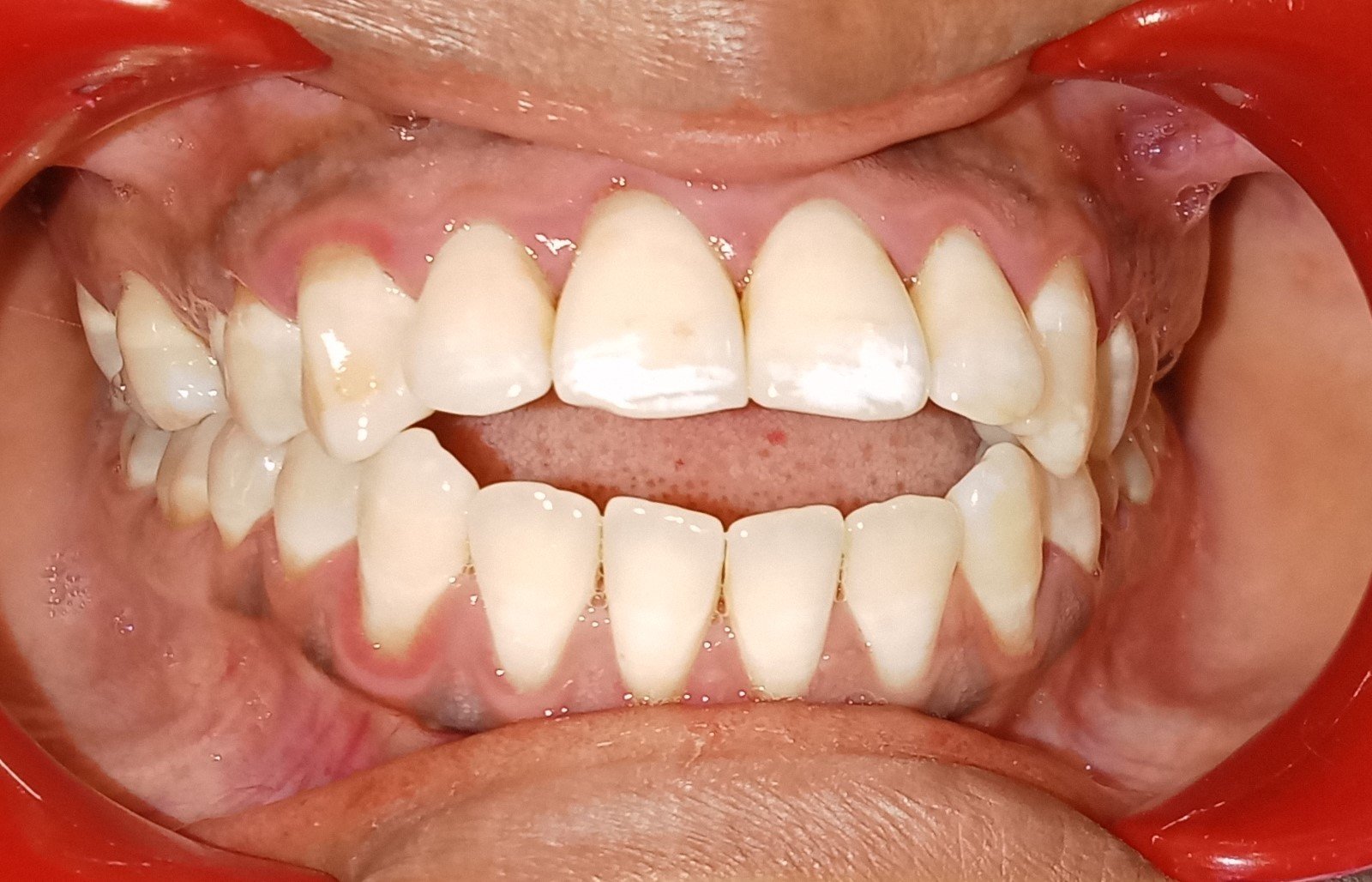 Before — frontal view showing anterior open bite gap