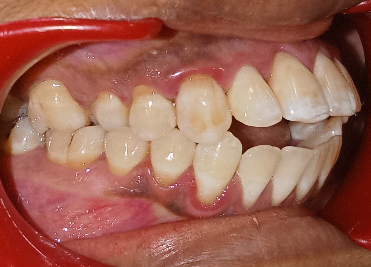 Before — right lateral view showing open bite