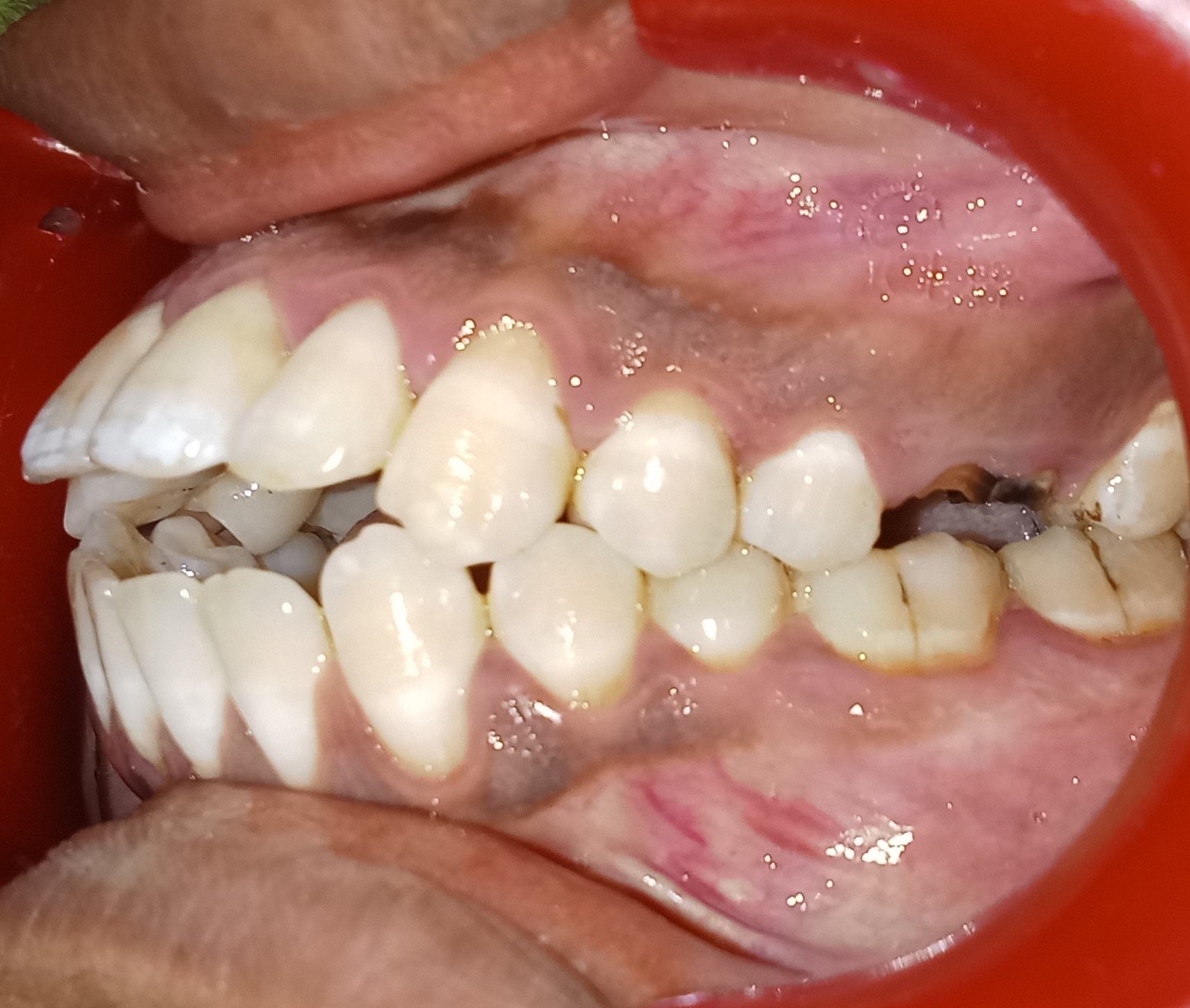 Before — left lateral view showing open bite