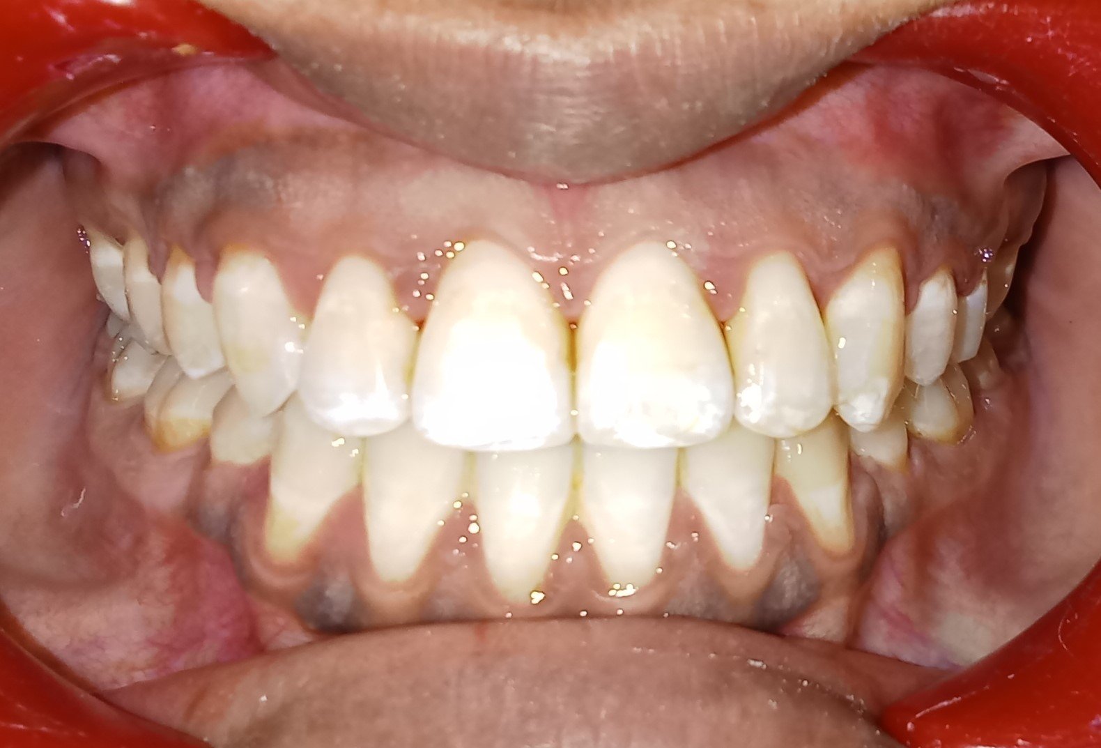 After — frontal view, anterior teeth in full contact