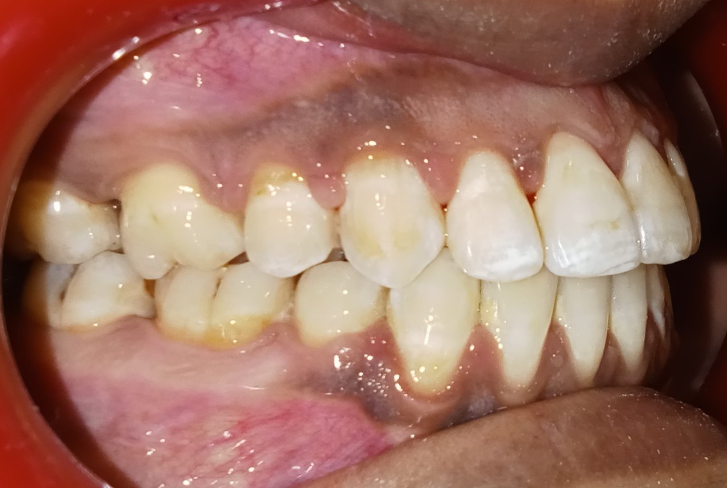 After — right lateral view