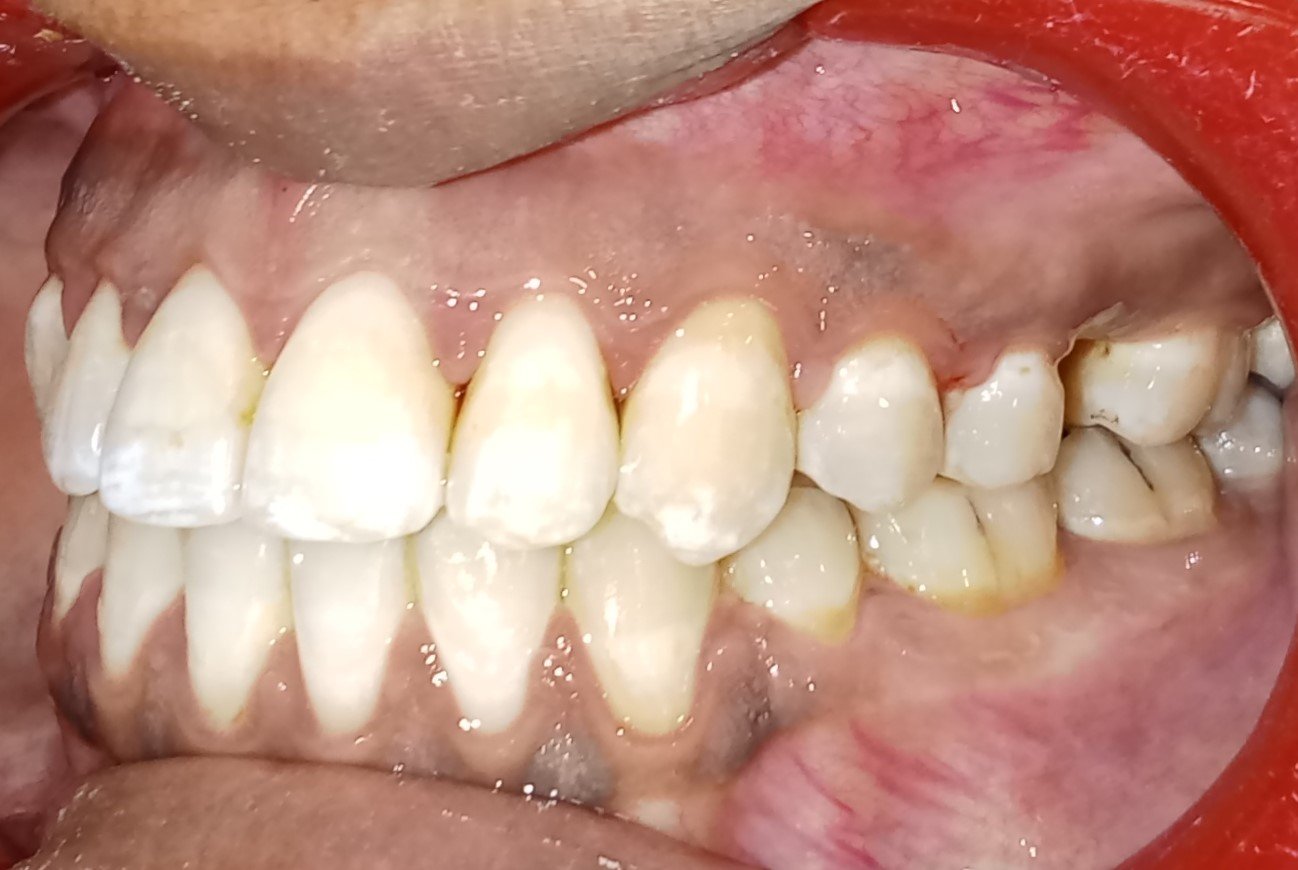 After — left lateral view