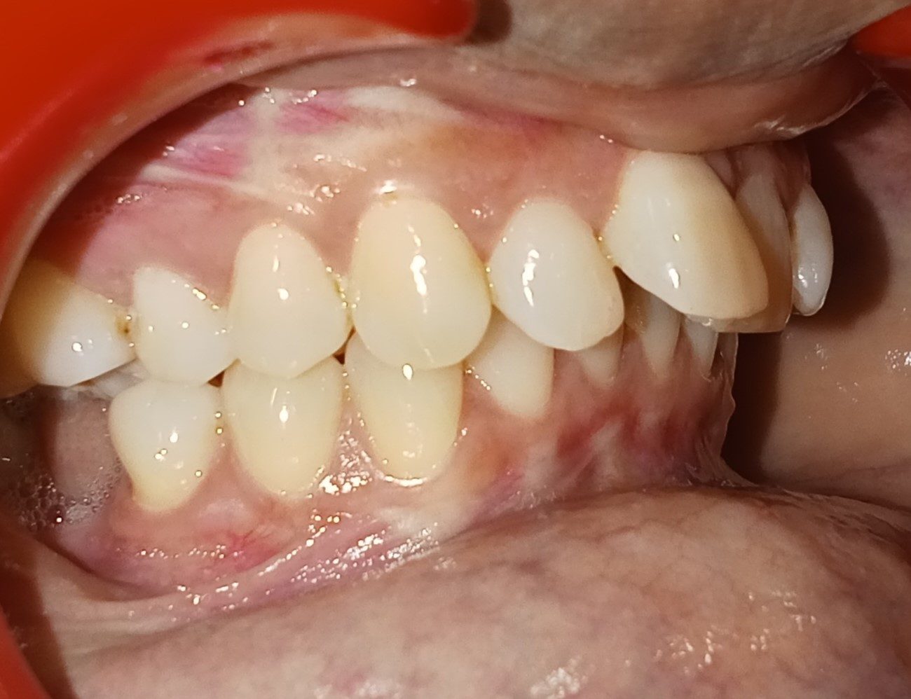 Before — skeletal Class II, 8.5mm overjet, proclined upper anteriors