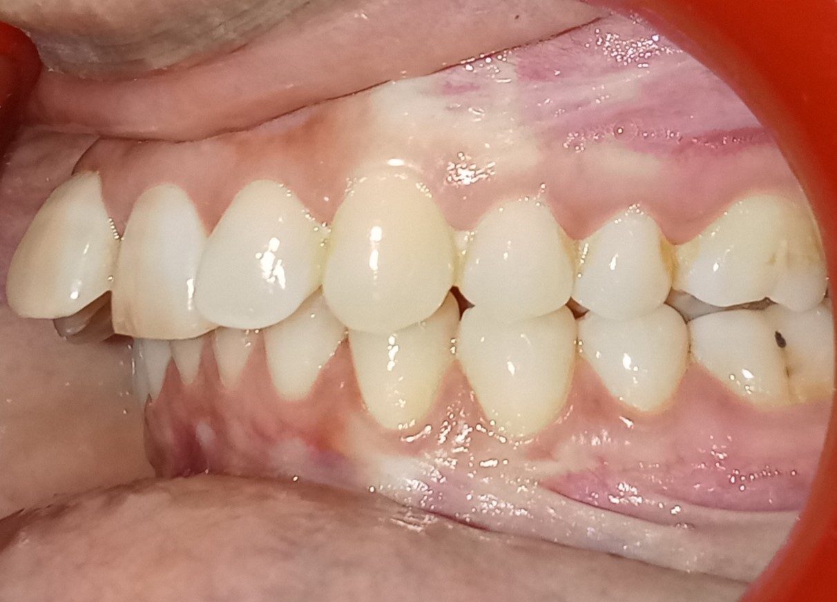 Before — left lateral view showing 8.5mm overjet