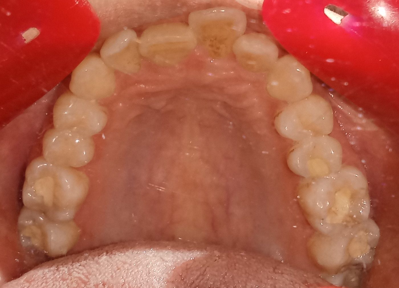 Before — upper arch occlusal view