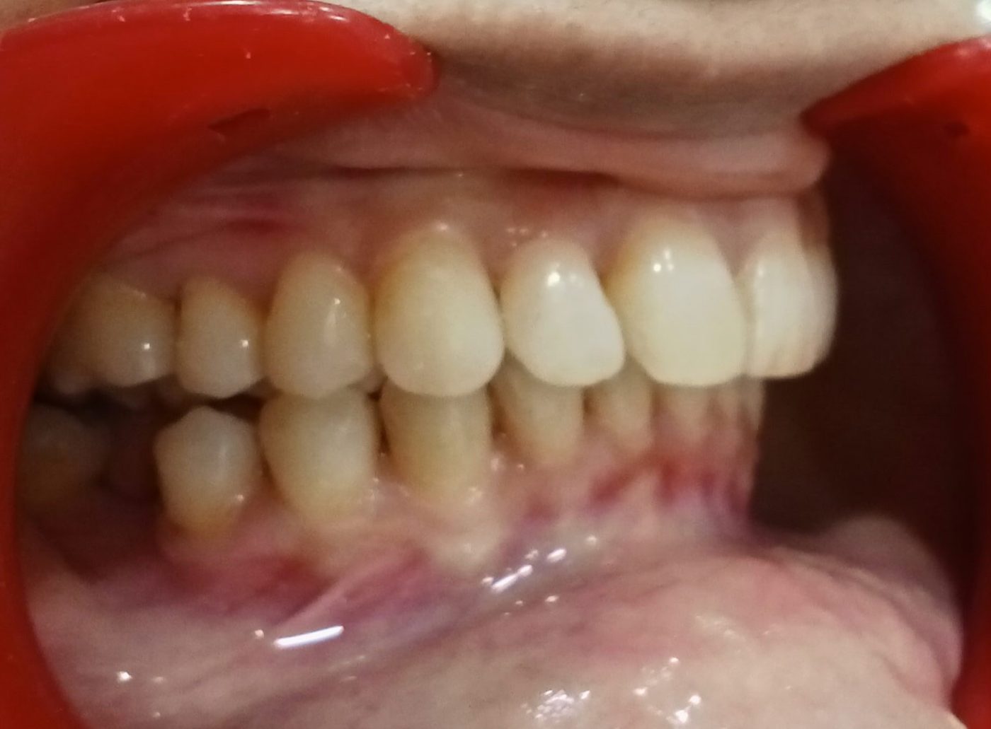 After — overjet reduced to 6mm with Invisalign