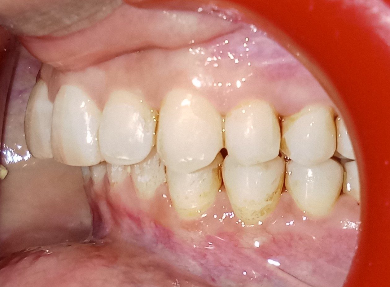 After — left lateral view, overjet reduced to 6mm