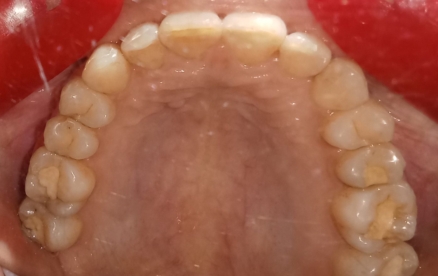 After — upper arch occlusal view