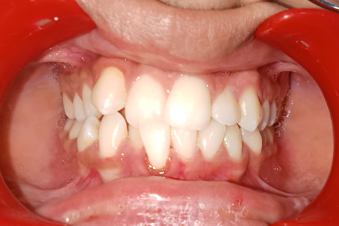 Before — frontal view showing crowding and reclined lower incisors
