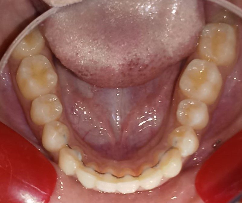 After — lower arch occlusal view, aligned with fixed retainer