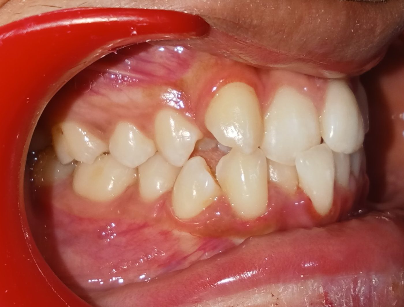 Before — right lateral view