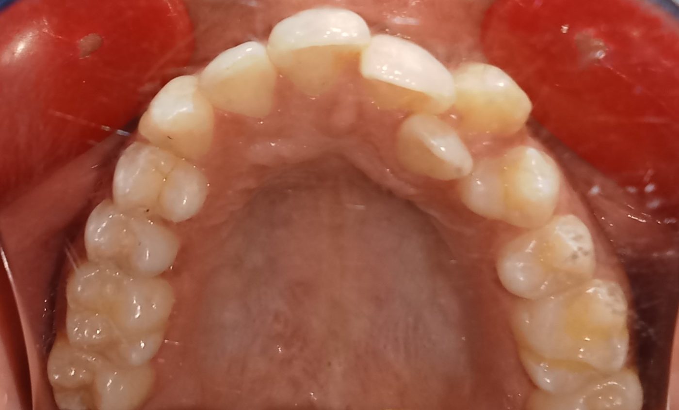 Before — upper arch occlusal view showing crowding